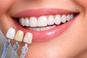 لمینت دندان چیست - نمونه انواع مدل لمینت دندان با ظاهر طبیعی