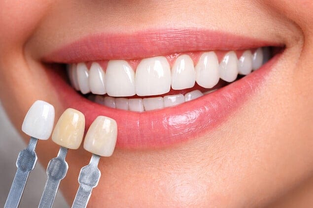لمینت دندان چیست - نمونه انواع مدل لمینت دندان با ظاهر طبیعی
