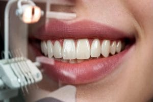 فرق لمینت و کامپوزیت چیست؟ راهنمای جامع انتخاب بهترین روش برای لبخند زیبا