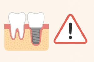 ایمپلنت دندان برای چه کسانی مناسب نیست و چه افرادی نباید ایمپلنت انجام دهند