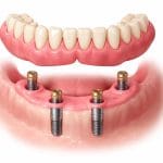 اوردنچر چیست و نحوه قرارگیری پروتز متحرک روی ایمپلنت