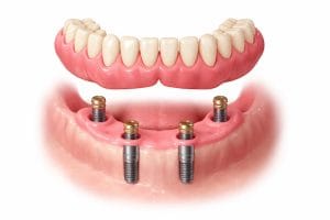 اوردنچر چیست و نحوه قرارگیری پروتز متحرک روی ایمپلنت