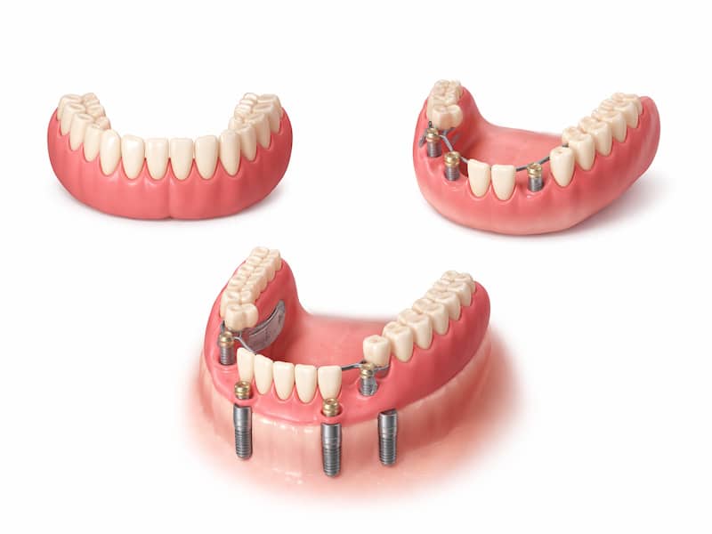 انواع پروتز متحرک شامل پروتز کامل، جزئی و اوردنچر