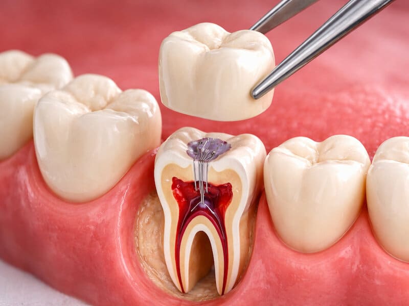آیا دندان عصب کشی شده باید روکش شود - ضرورت روکش پس از درمان ریشه