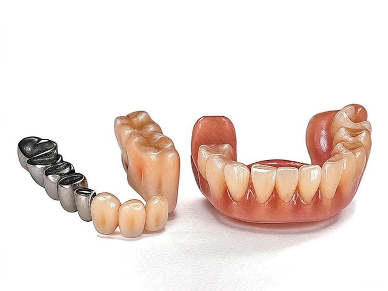 اوردنچر-تصویر شماتیکی از اتصال اوردنچر به دو یا چهار ایمپلنت در فک پایین