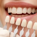 رنگ بندی لمینت دندان