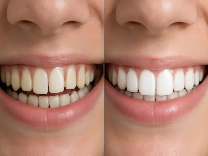 عکس دندان هایی که نیاز به ارتودنسی دارند در مقابل کامپوزیت دندان چند سال دوام دارد