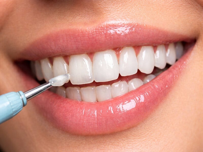 تکنیک کامپوزیت لبه شیشه ای در لبخند طبیعی