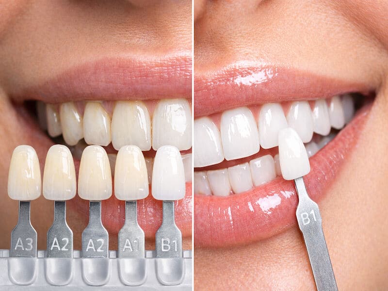 رنگ بندی کامپوزیت دندان و مقایسه سفیدترین رنگ کامپوزیت دندان