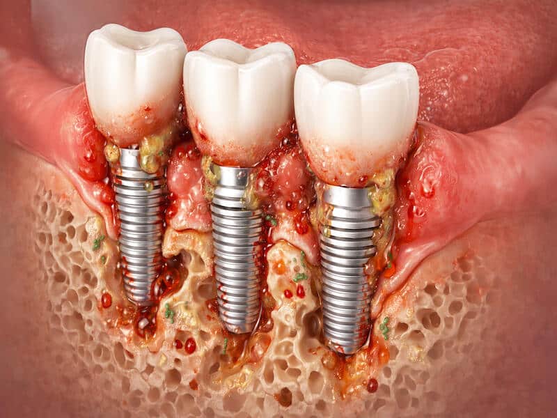علت ورم لثه بعد از ایمپلنت و تحلیل استخوان در پری‌ایمپلنتیتیس