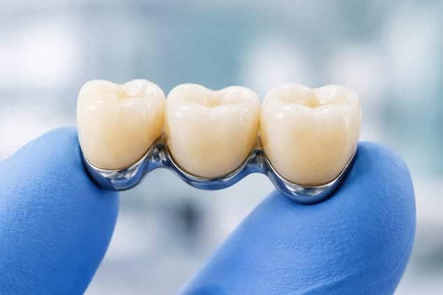 روکش دندان متصل به هم یا بریج دندان برای پر کردن جای خالی دندان در کلینیک آرنیک