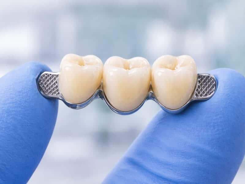 مریلند بریج به عنوان نوعی روکش دندان متصل به هم با تراش کمتر