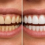 لمینت ایمکس قبل و بعد | نمونه کار واقعی کلینیک آرنیک ۱۴۰۴