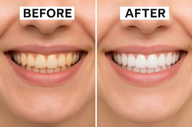طول عمر بلیچینگ دندان - مقایسه قبل و بعد - کلینیک دندانپزشکی آرنیک