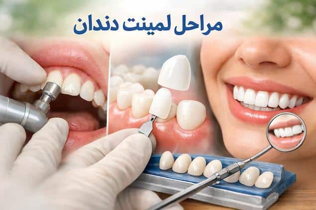 مراحل لمینت دندان در کلینیک آرنیک: قبل و بعد طبیعی لمینت سرامیکی