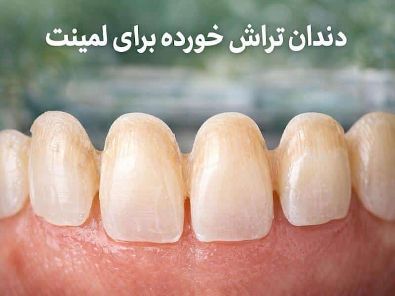 عکس دندان تراش خورده برای لمینت: آماده‌سازی دقیق مینیمال