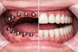 قبل و بعد پرکردن جای خالی دندان با ایمپلنت همه دندان ها در کلینیک آرنیک