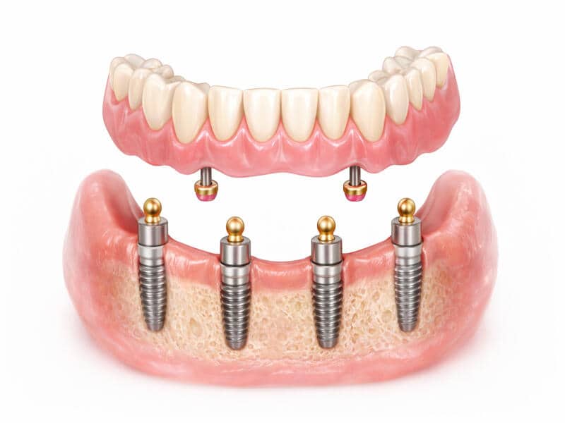 نتایج ایمپلنت همه دندان (ایمپلنت فول موس) قبل و بعد