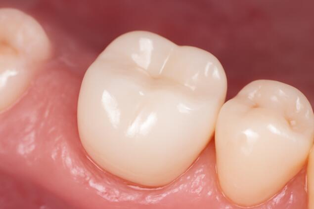 عکس روکش پی اف ام - روکش دندان پرسلن متصل به فلز در کلینیک آرنیک