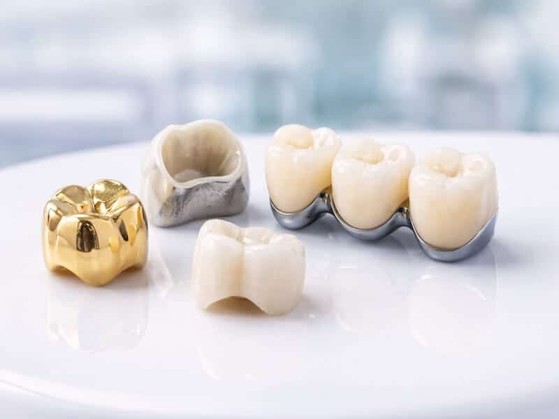 انواع روکش دندان از جمله روکش دندان طلا و زیرکونیا