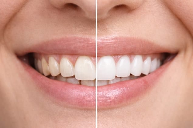 قبل و بعد لمینت دندان زیرکونیا در کلینیک آرنیک: لبخند طبیعی و مقاوم