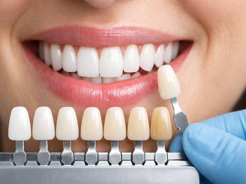 انتخاب رنگ لمینت دندان و رنگ های لمینت دندان طبیعی