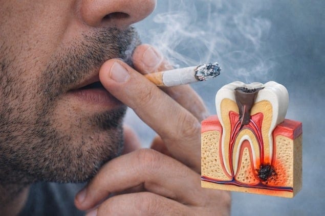 آیا بعد از عصب کشی دندان میتوان سیگار کشید - اثرات منفی سیگار