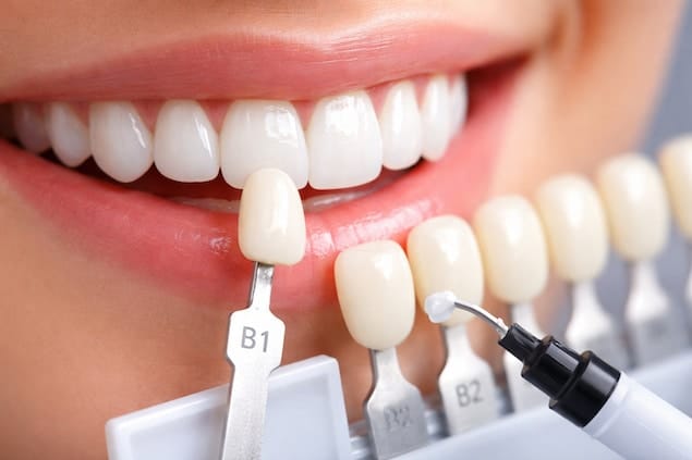 سفیدترین رنگ کامپوزیت دندان: راهنمای انتخاب رنگ کامپوزیت دندان در آرنیک