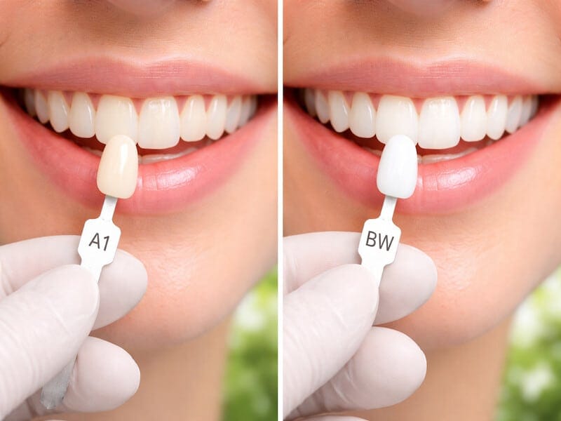 مقایسه سفیدترین رنگ کامپوزیت دندان A1 و BW در نور طبیعی