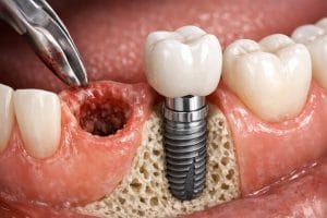 ایمپلنت بعد از کشیدن دندان - نمایش قرارگیری پایه تیتانیومی در استخوان فک
