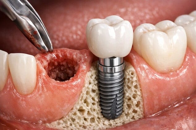 ایمپلنت بعد از کشیدن دندان - نمایش قرارگیری پایه تیتانیومی در استخوان فک
