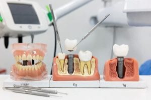 سختترین مرحله ایمپلنت دندان و مراحل کامل کاشت در کلینیک دندانپزشکی آرنیک