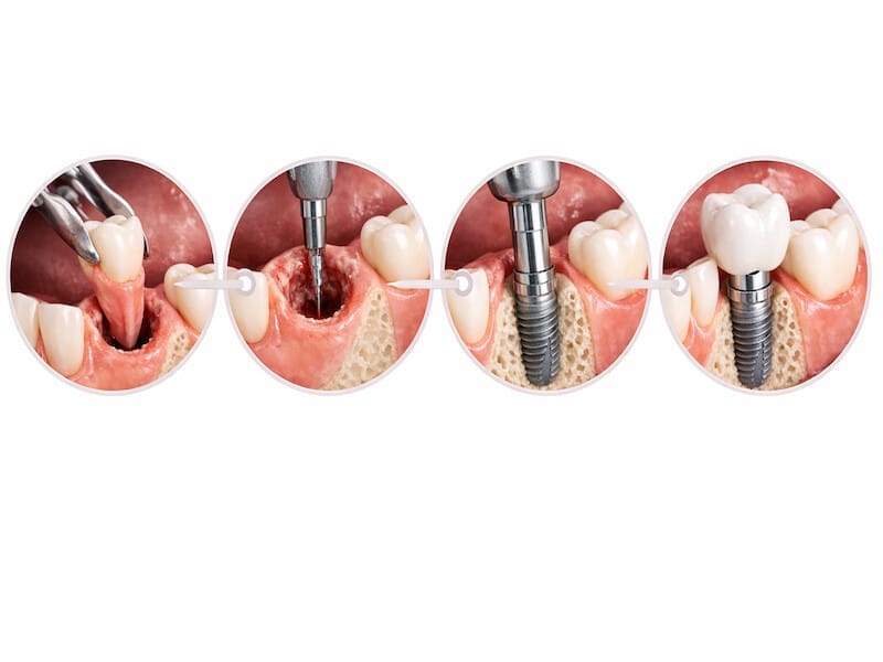 ایمپلنت بلافاصله بعد از کشیدن دندان - مراحل جراحی و کاشت فوری