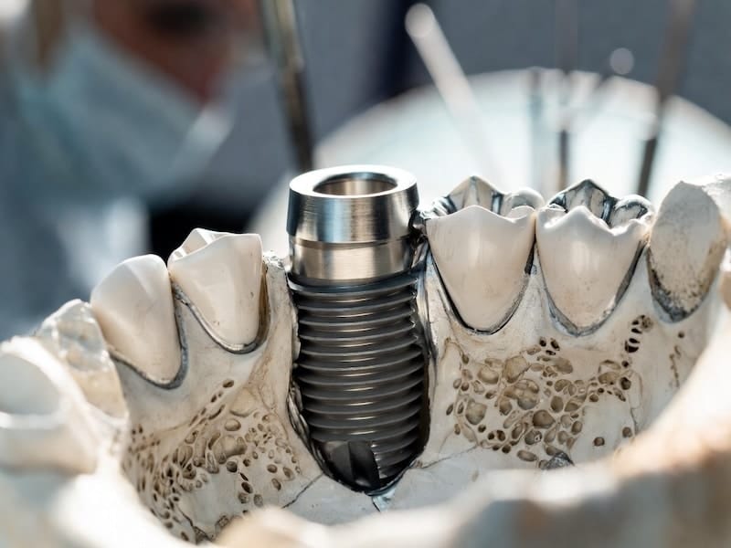 مرحله استئواینتگریشن در ایمپلنت دندان و سخت ترین مرحله ایمپلنت