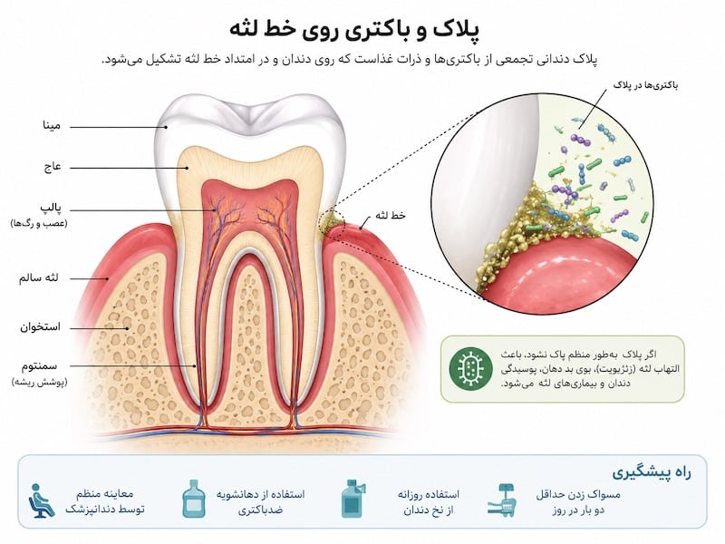 آناتومی و علت عفونت لثه در ساختار دندان